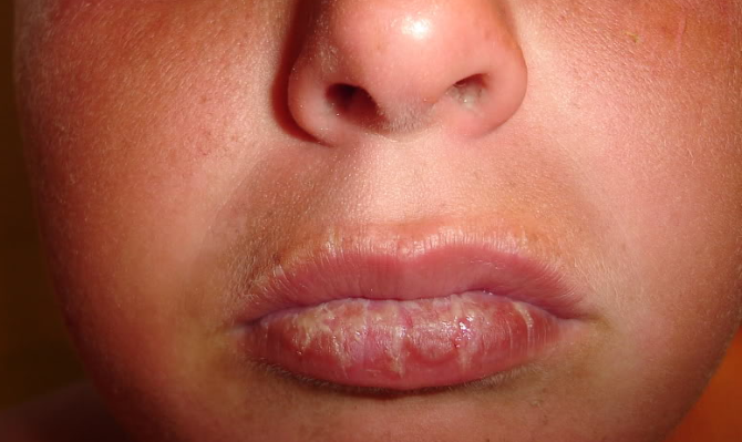 Skin Cancer Alert! Don't skip the lips! - Brosy Family Dentistry