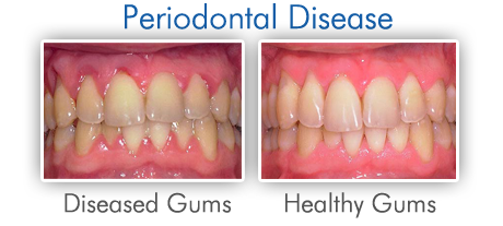 charcoal and gum disease