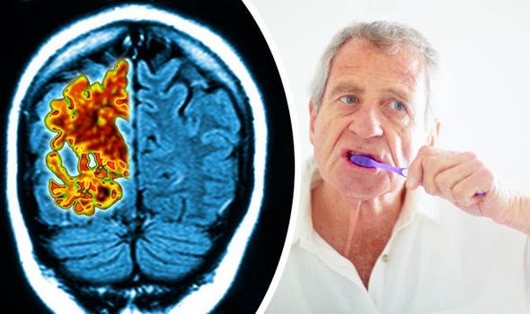 Alzheimer’s and Oral Health